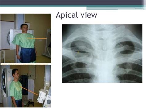 apicolordotic view position.